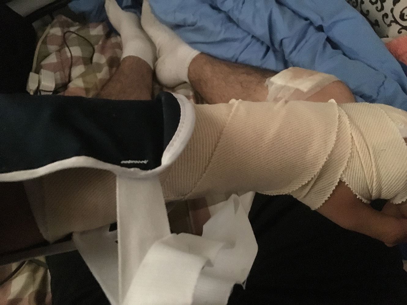 Broken arm from Lyft scooter accident